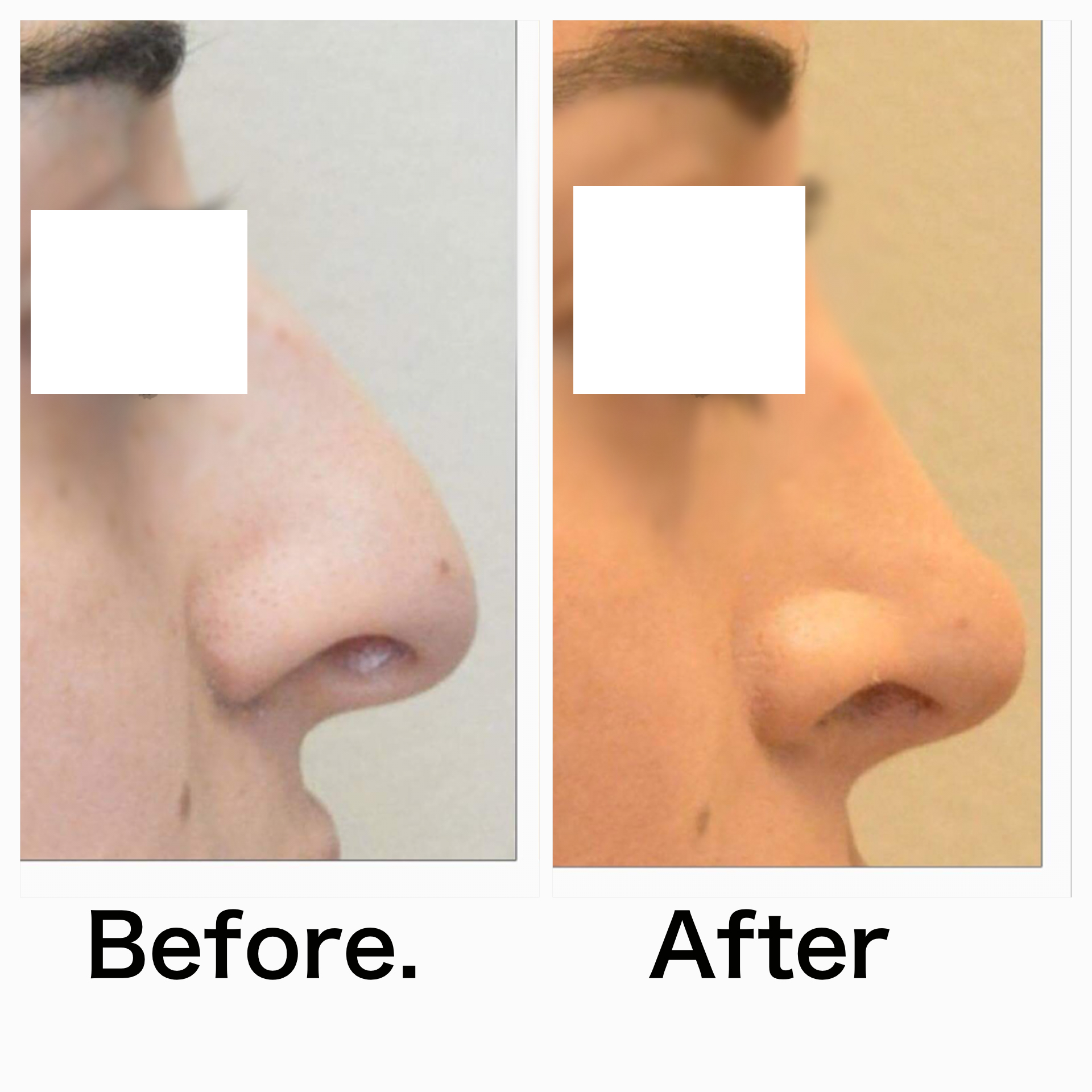 Rhinoplasty surgery before and after #15