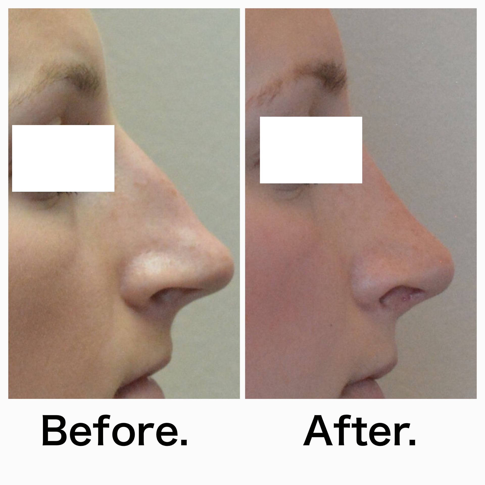 Rhinoplasty surgery before and after #11
