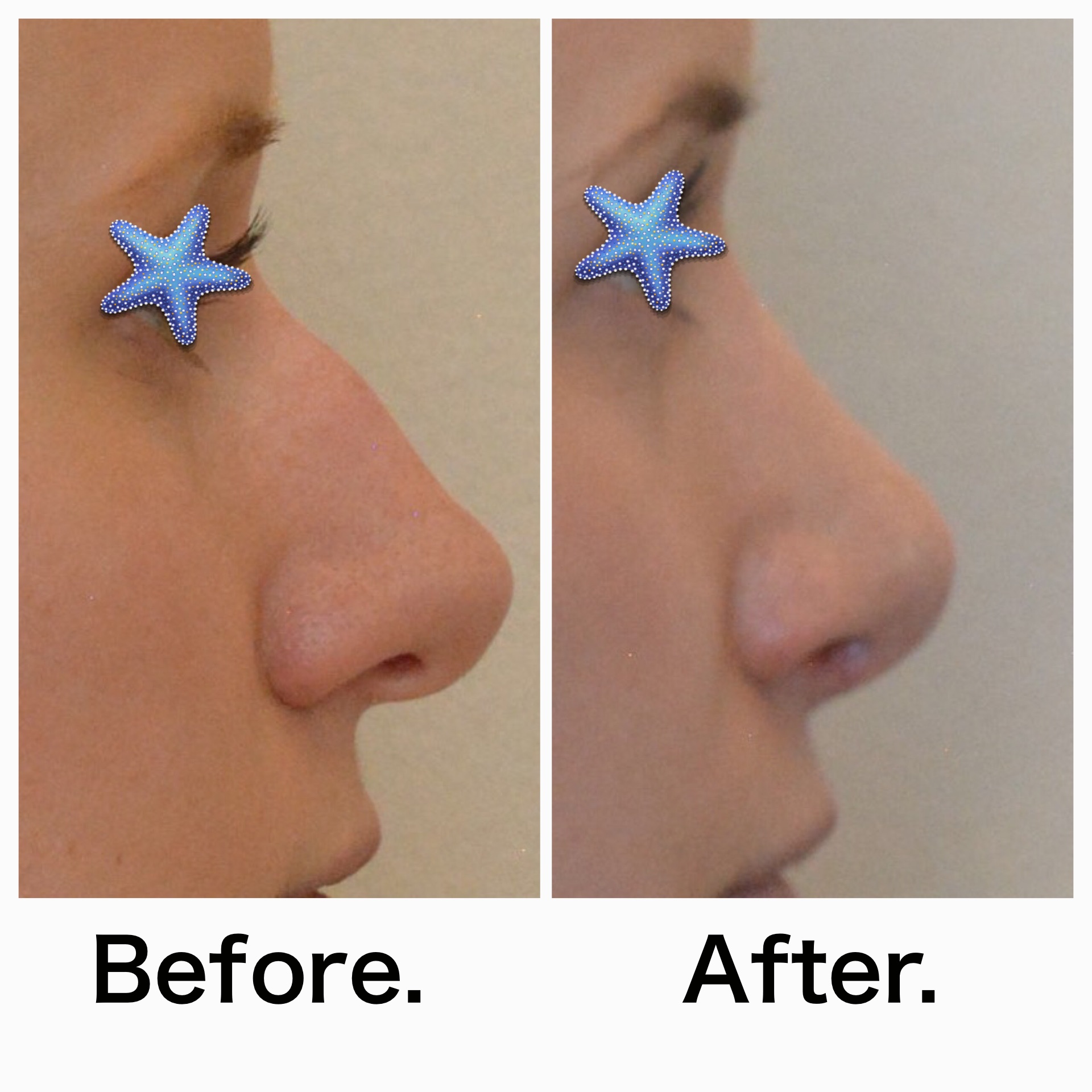 Rhinoplasty surgery before and after #12