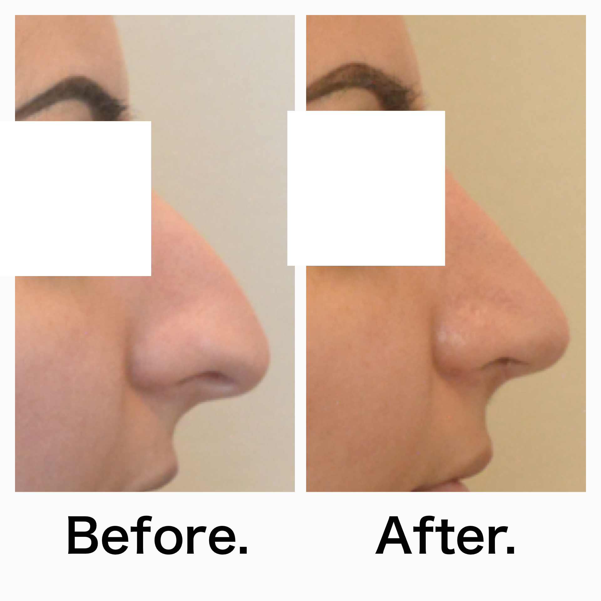 Rhinoplasty surgery before and after #13