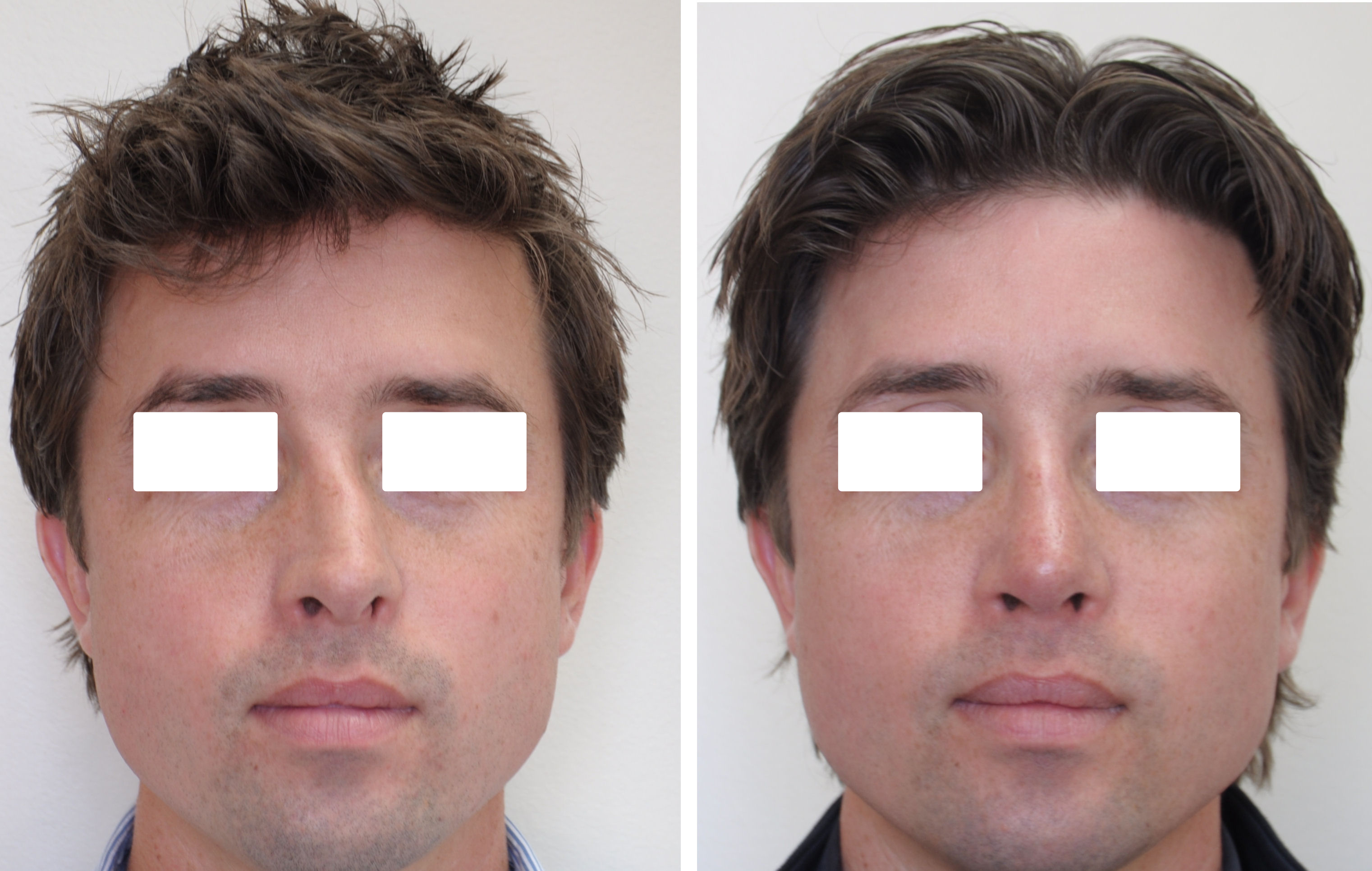 Rhinoplasty surgery before and after #5