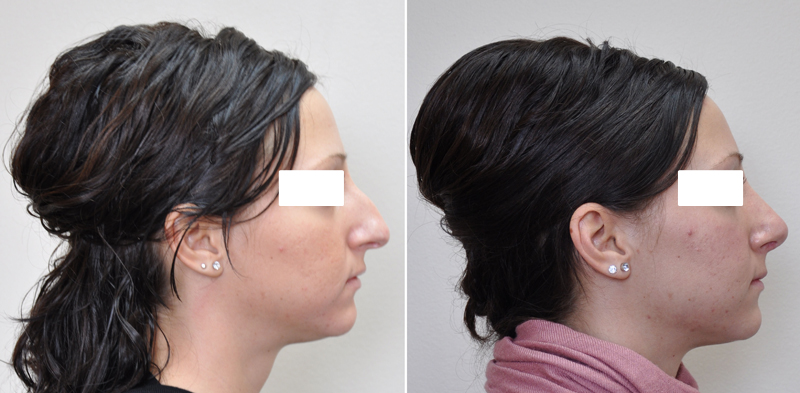 Rhinoplasty surgery before and after #1