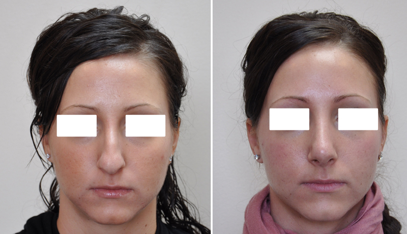 Rhinoplasty surgery before and after #3