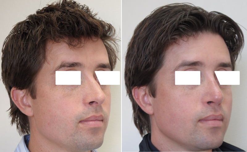 Rhinoplasty surgery before and after #4