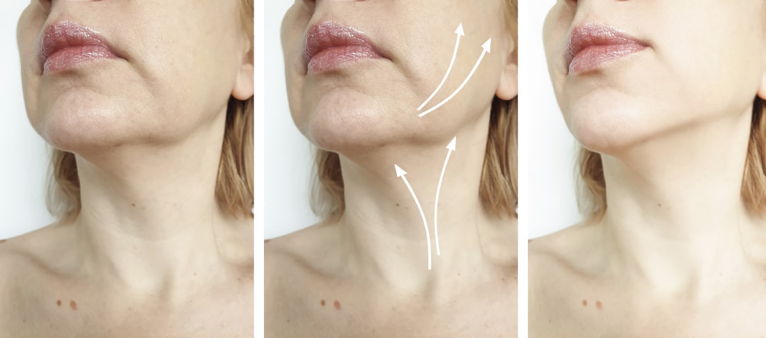 advantages-of-optimum-mobility-facelift